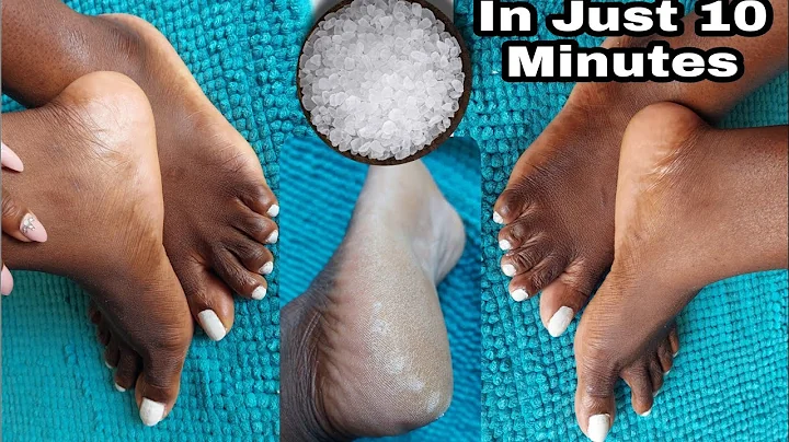 HOW TO REMOVE DEAD SKIN FROM YOUR FEET NATURALLY AT HOME 2021| CRACKED HEELS HOME REMEDY - DayDayNews