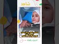 اصدقائي الأطفال تجنبوا التعامل مع مصادر النار الحروق خطيرة وتسبب التشوه
