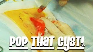 May Vee's Cyst Removal! Blackhead Removal Tools & Meta-Seven 360