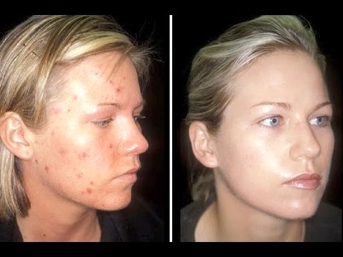 HOW TO GET RID OF ACNE - FACE, BACK, CHEST, ARM, LEG - OFFICIAL HOW TO CURE ACNE