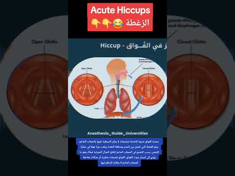 الزغطة الفواق   أسبابه وعلاجه انشروها للاستفادة