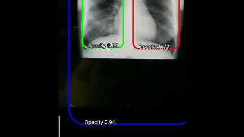 Tensorflow Pneumonia Detector