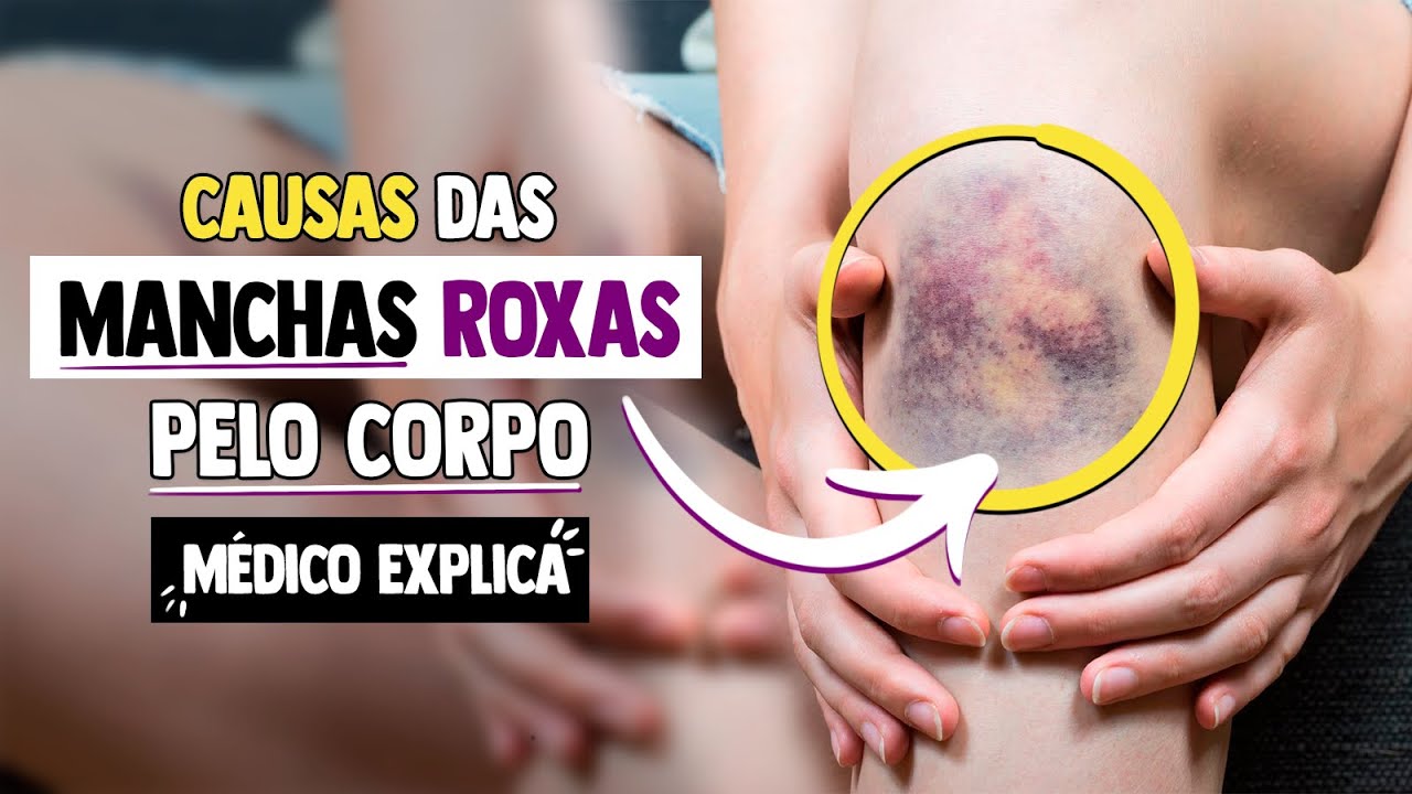 Manchas Roxas no corpo: Causas? Por que aparecem? São perigosas ...