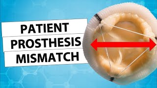 Patient Prothesis Mismatch How To Avoid It?