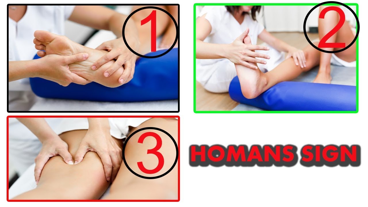 Homans Sign Homans Sign Symptoms Positive And Nagative Homans Sign Youtube