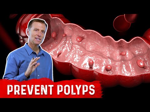 The Best Food for Polyps in the Colon
