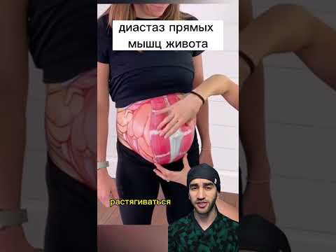 мышцы живота разошлись