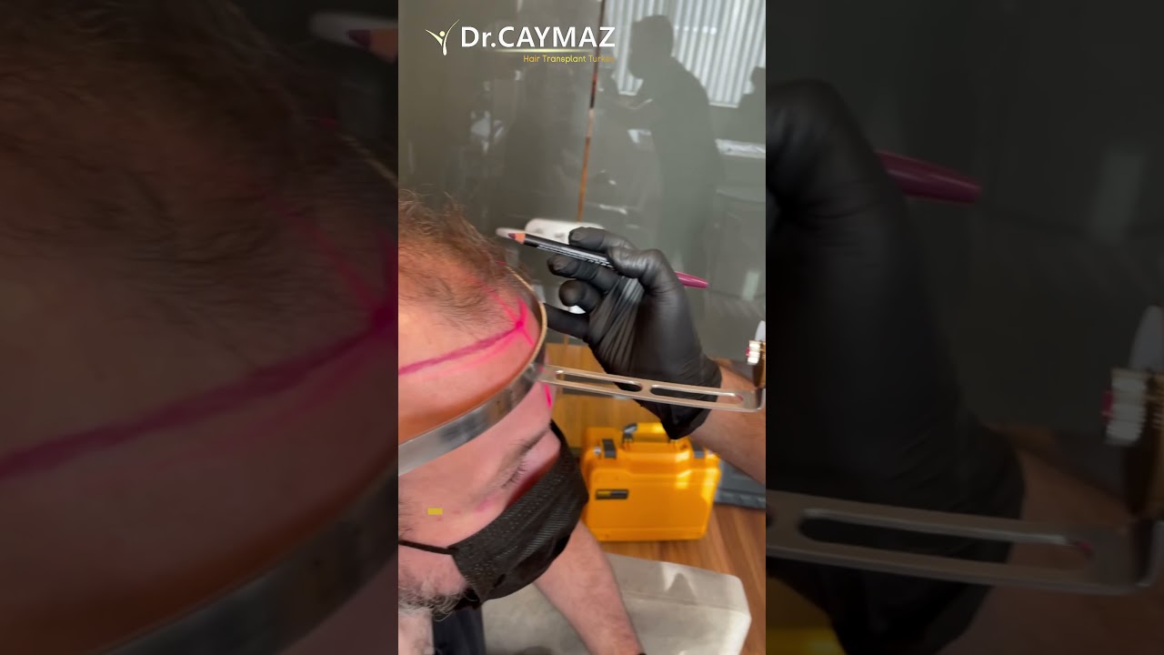 Hair Line Design with Laser by Medical Doctor