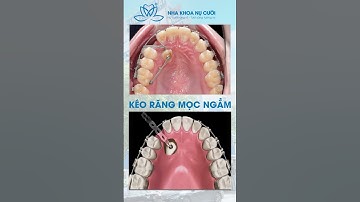 KÉO RĂNG MỌC NGẦM TRONG CHỈNH NHA