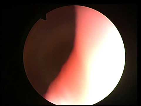 bladder cystoscopy biopsy