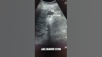 Gallbladder stone abdominal ultrasound #education #ultrasound #medical #anatomy #sonography #edukasi