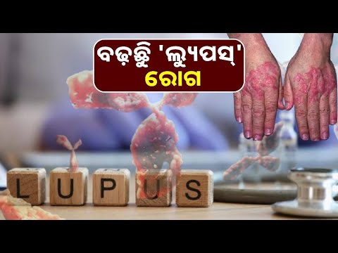ଉତ୍ତର ଭାରତରେ ବଢ଼ିବାରେ ଲାଗିଛି 'ଲ୍ୟୁପସ୍' ରୋଗର ମାମଲା, ଶରୀରର ସବୁ ଅଙ୍ଗକୁ କରୁଛି ଆକ୍ରାନ୍ତ