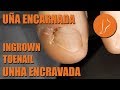 Ingrown toenail - Unha encravada - Uña encarnada - Espícula [Podología Integral]