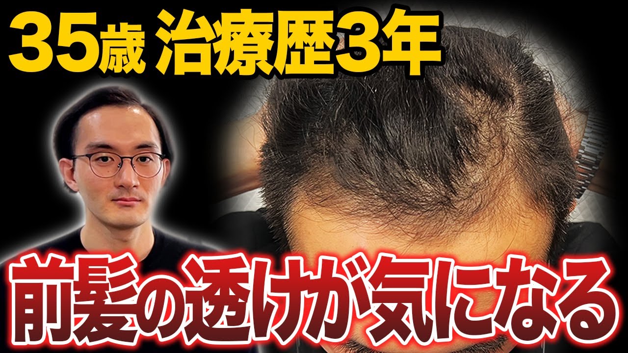 初登場!!】AGA治療歴3年で限界を感じた35歳が植毛に挑戦！【30代