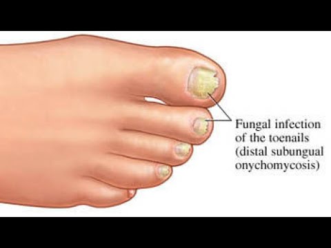 How To Soften Thick Toenails