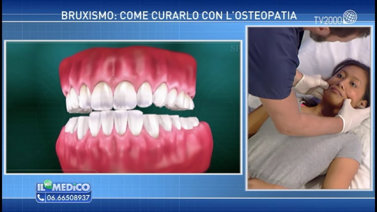 Bruxismo e Mandibola - Dr Gabriele Benedetti