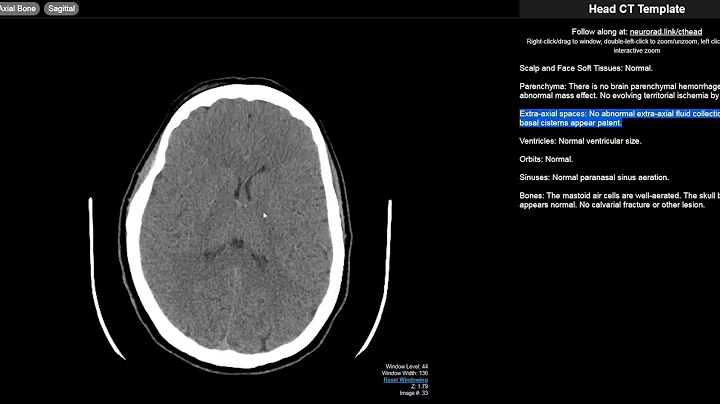 Radiology Walkthroughs - CT Head