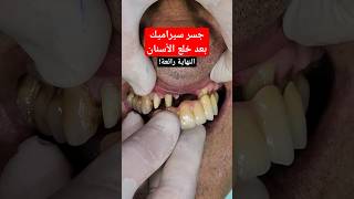 تركيبات اسنان بعد خلع الاسنان الامامية