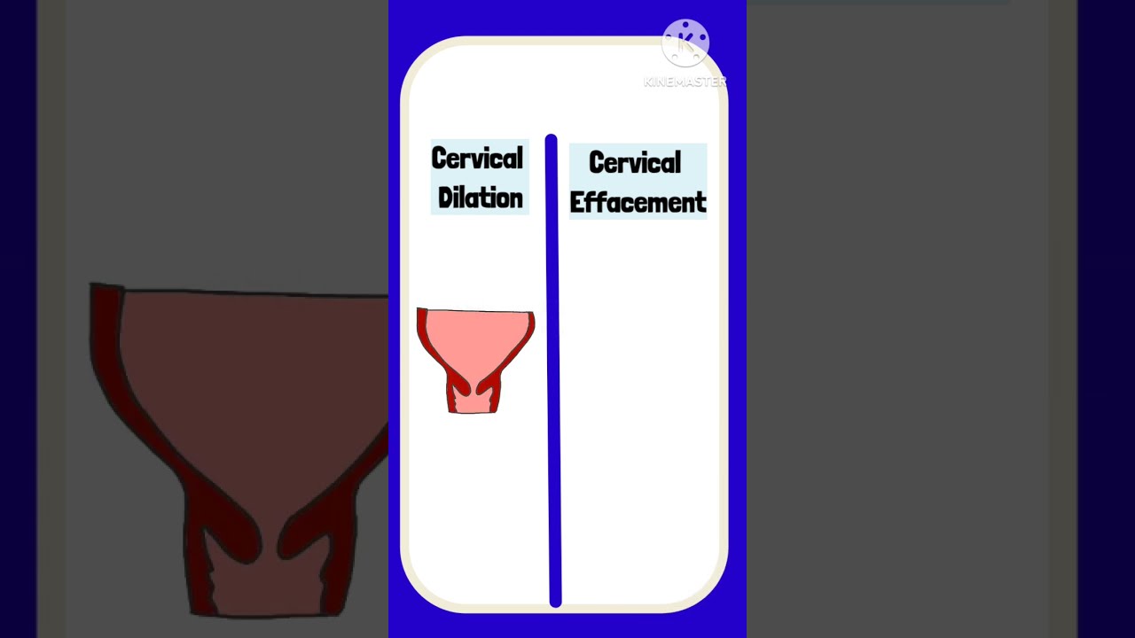 Cervical Dilation Vs Effacement Pregnancy Cervix Labour Obstetrics