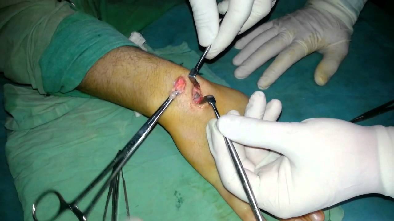 مستشفى السلام الجراحي: استئصال كيسة مائية من اليد - YouTube