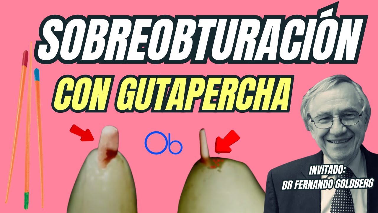 Sobreobturación con Gutapercha 🦷 con el Dr Fernando Goldberg