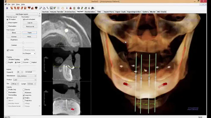 Cone Beam CT Interpretation for Zest LODI Implants...