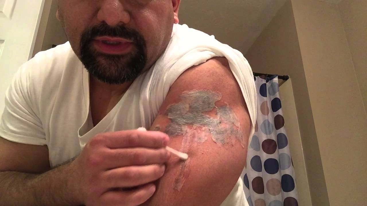 TCA 50 Tattoo Removal 1st Application Part 1 of 2 YouTube
