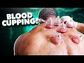 BLOOD CUPPING!