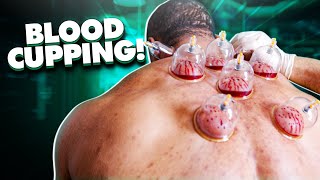 BLOOD CUPPING!