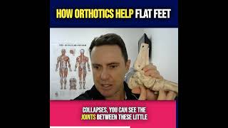 How Orthotics Help Flat Feet