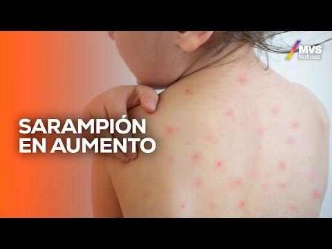 SARAMPIÓN: por qué REGRESÓ y qué tan en RIESGO estamos | RETOS con Carlos Campos