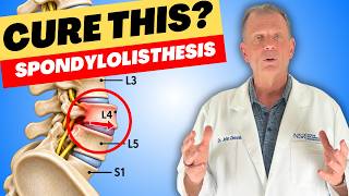 Spondylolisthesis: Can It Be Cured Here's What Actually Works!