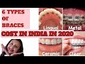 Types of braces and cost in indialife of a young dentist