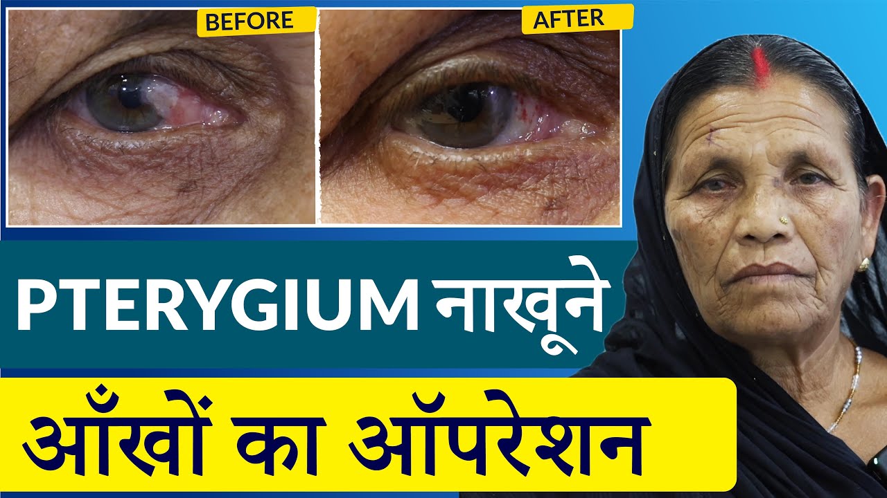 Pterygium Pterygium Treatment Best Cornea pterygium-pterygium-treatment-best-cornea