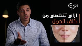 إزاي تتخلصي من كلف الحمل