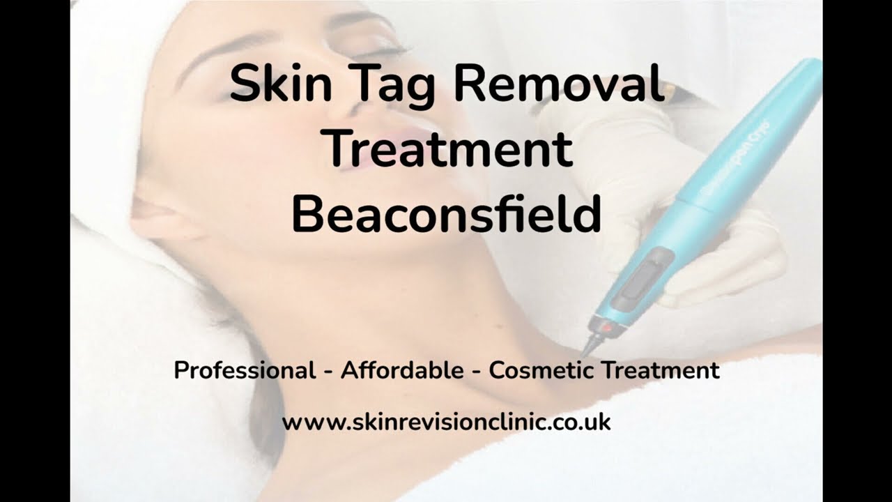 Skin Tag Removal Treatment Beaconsfield