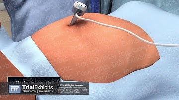 Laparoscopic Trocar Placement Under Direct Visualization