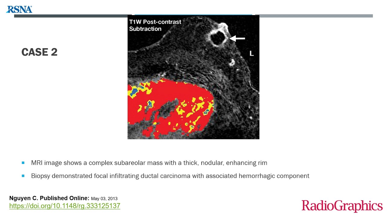 Abnormalities of the Male Breast | Free Radiology CME