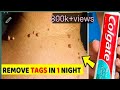 ನರಹುಲಿ ಗೆ ಮನೆ ಮದು|how to remove skin tag