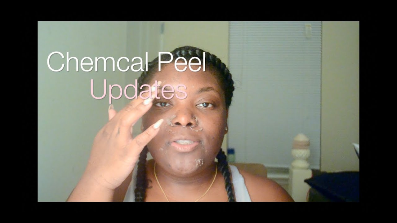 Chemical Peel On Dark Skin 2015 Youtube