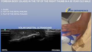 Ultrasound of a Foreign Body (Glass) in the Tip of the Right Thumb in a 36 Year Old Male