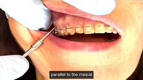 Inserting A TAD Into The Zygomatic Crest