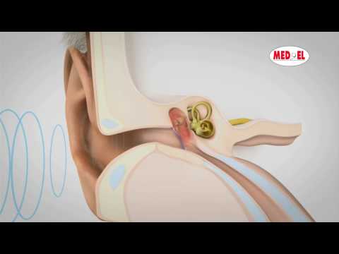 Mixed Hearing Loss Sensorineural and Conductive Hearing Loss | MED-EL