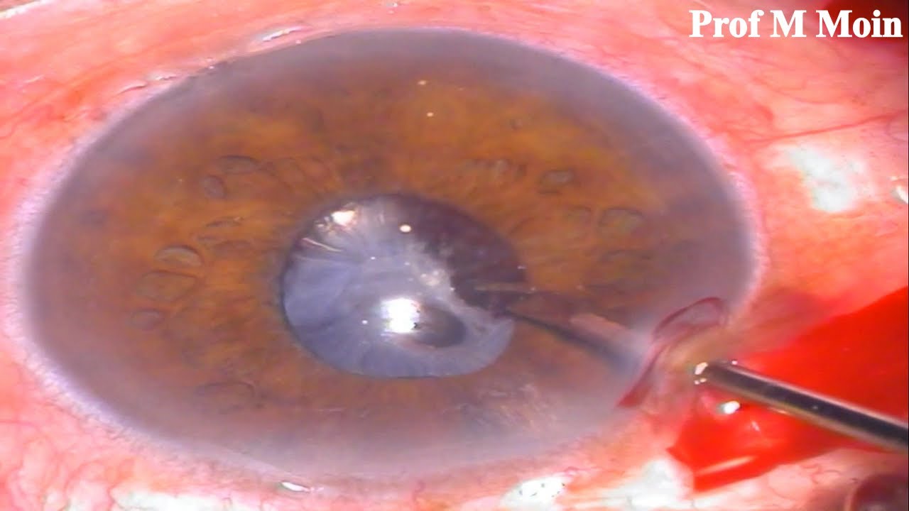 Anterior Capsular Phimosis; Surgical Management YouTube