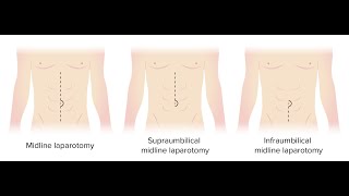 Exploratory Laparotomy Cpt Code - Simplify Medical Coding