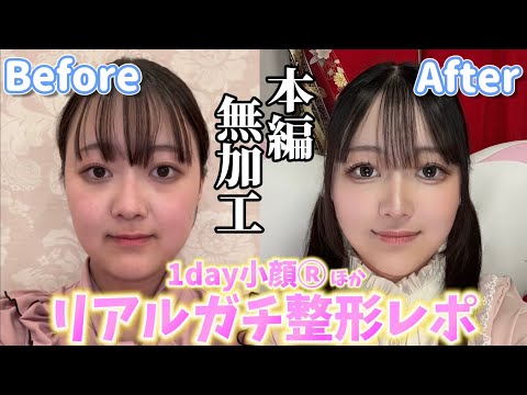 【初整形】念願の1day小顔®︎で理想の輪郭に…！