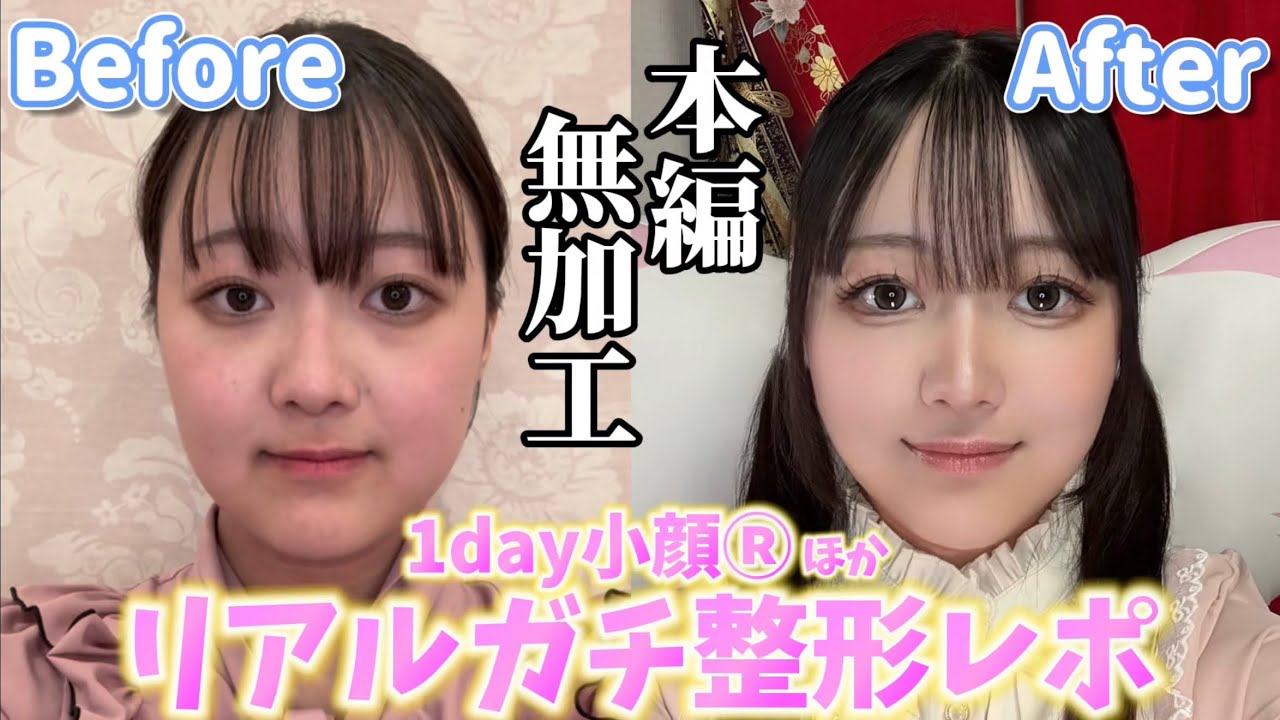 【初整形】念願の1day小顔®︎で理想の輪郭に…！