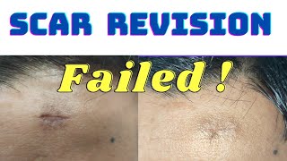 Re- doo scar revision surgery| Failed scar revision surgery| Scar revision surgery in Ranchi