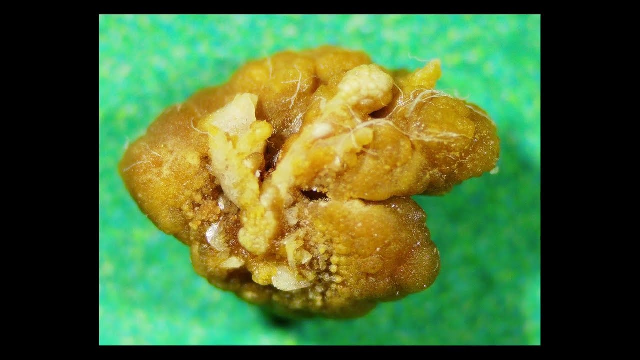 5 Mm Kidney Stone Seen Under Digital Microscope YouTube 5 Mm Kidney Stone Seen Under Digital Microscope YouTube