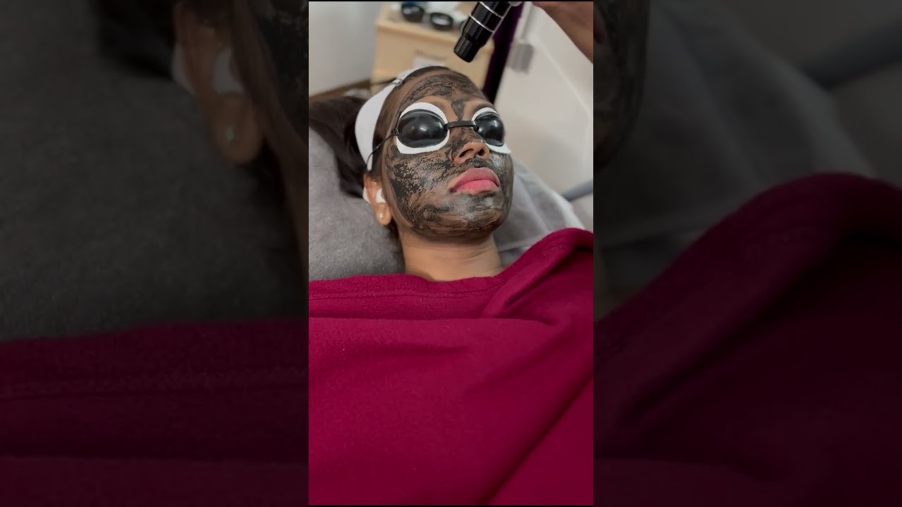 Laser Carbon Facial